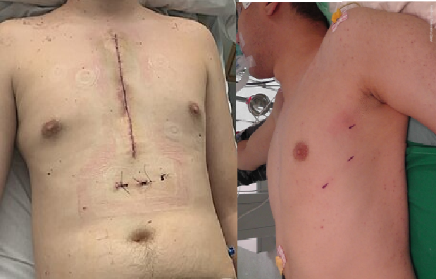 الفرق بين جروحاستئصال الغدة التيموسيه (الزعترية) بالمنظار لعلاج الوهن العضلي (Myasthenia Gravis) المنظار والجراحه التقليديه